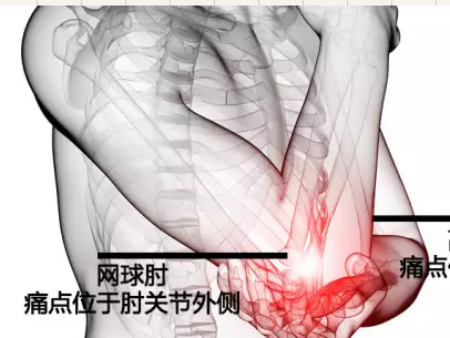 网球肘.jpg