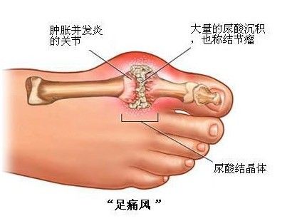 痛风早期的发作症状.jpg 痛风早期的发作症状.jpg