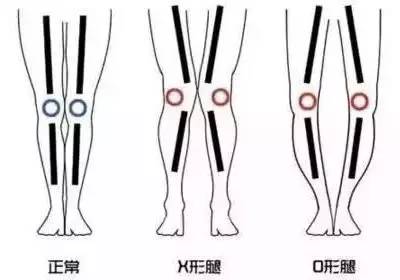 x形腿 x形腿