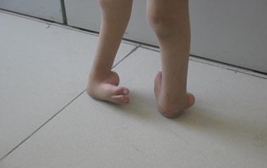 马蹄足治疗.jpg 马蹄足治疗.jpg