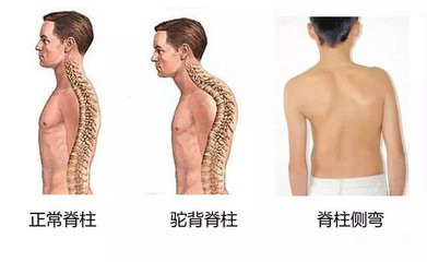 脊柱侧凸的症状1.jpg 脊柱侧凸的症状1.jpg