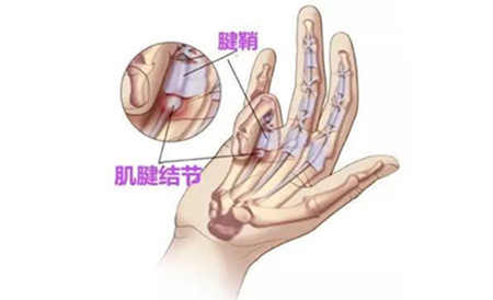 大拇指腱鞘炎.jpg 大拇指腱鞘炎.jpg