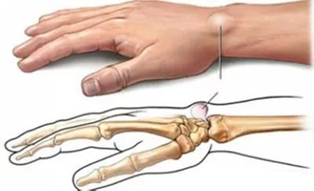 腱鞘炎1.jpg 腱鞘炎1.jpg