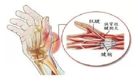 大拇指腱鞘炎.jpg 大拇指腱鞘炎.jpg