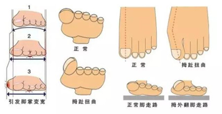 拇外翻.jpg 拇外翻.jpg