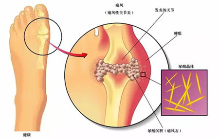 痛风的原因及治疗、.jpg 痛风的原因及治疗、.jpg