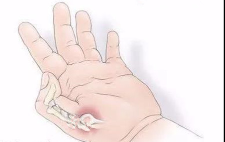 拇指腱鞘炎1.jpg 拇指腱鞘炎1.jpg